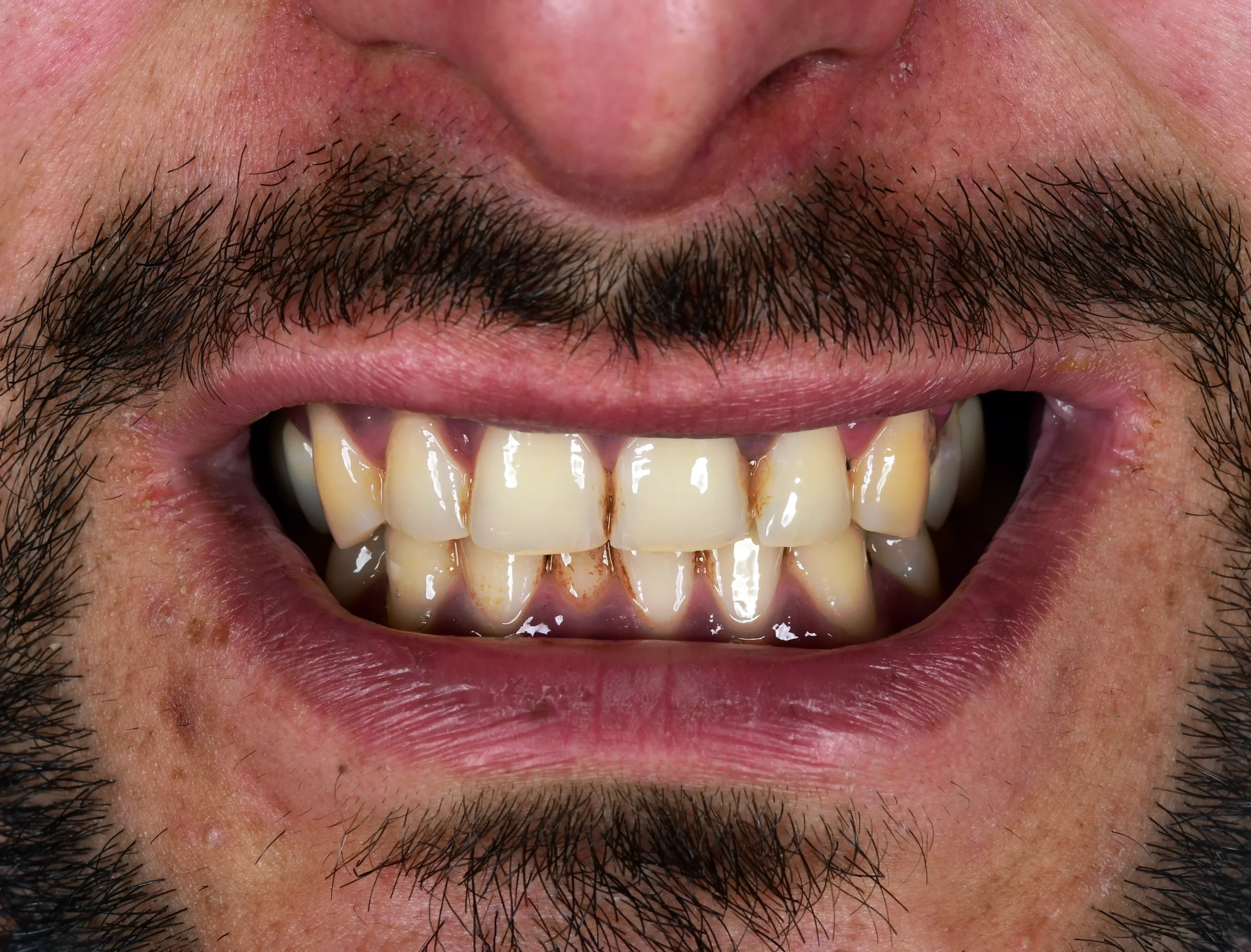 Hollywood Smile Makeover — Before