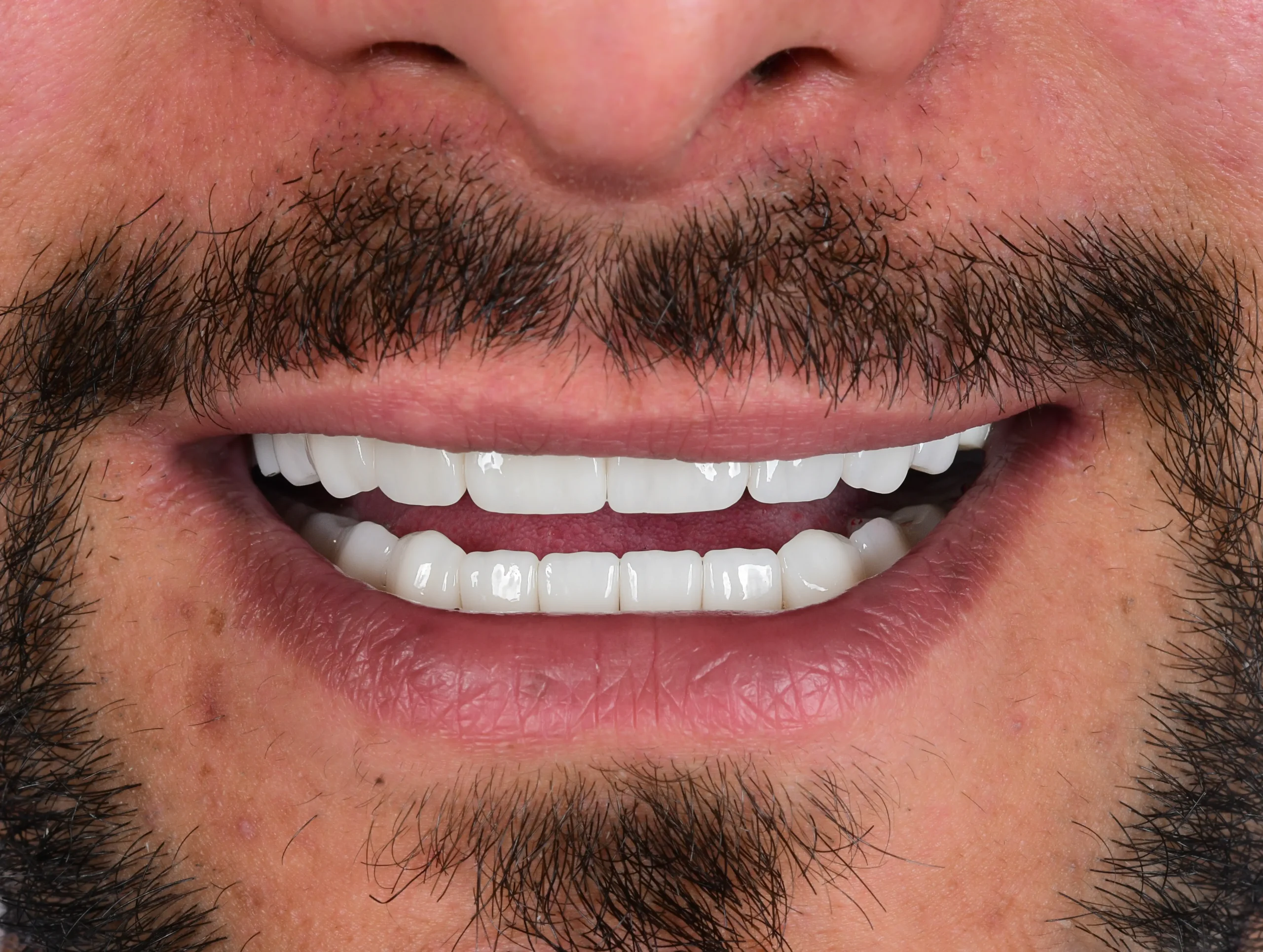 Hollywood Smile Makeover — After