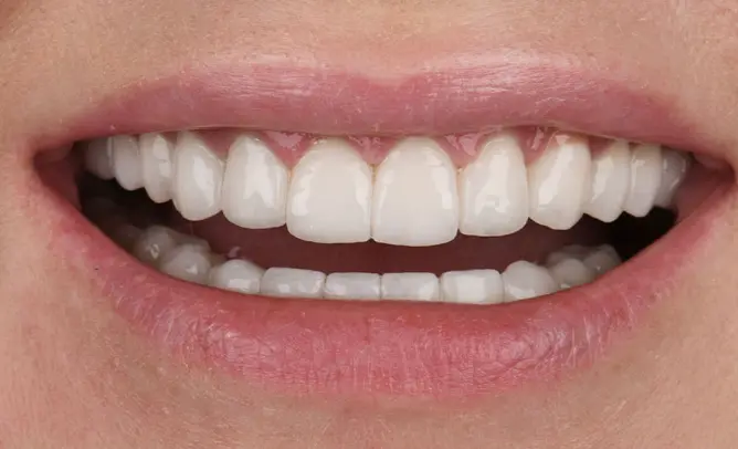 Natural Smile Makeover — After