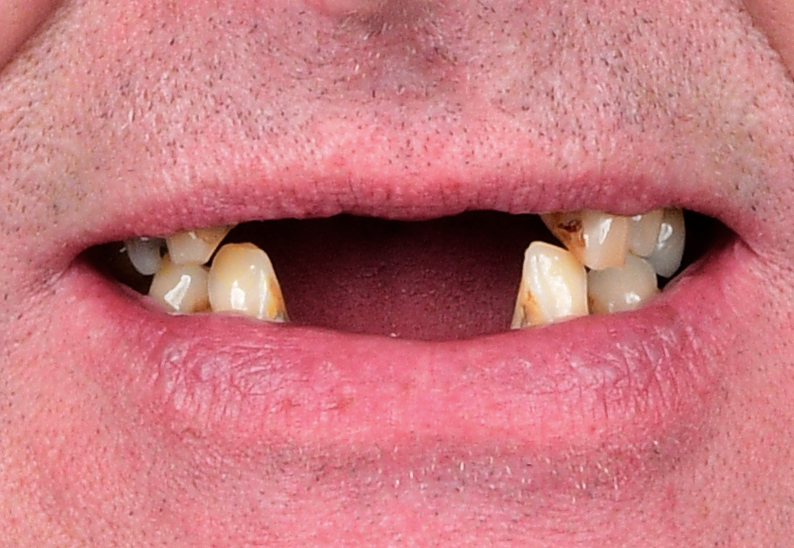 All On 6 Treatment — Before