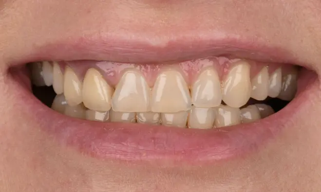 Natural Smile Makeover — Before