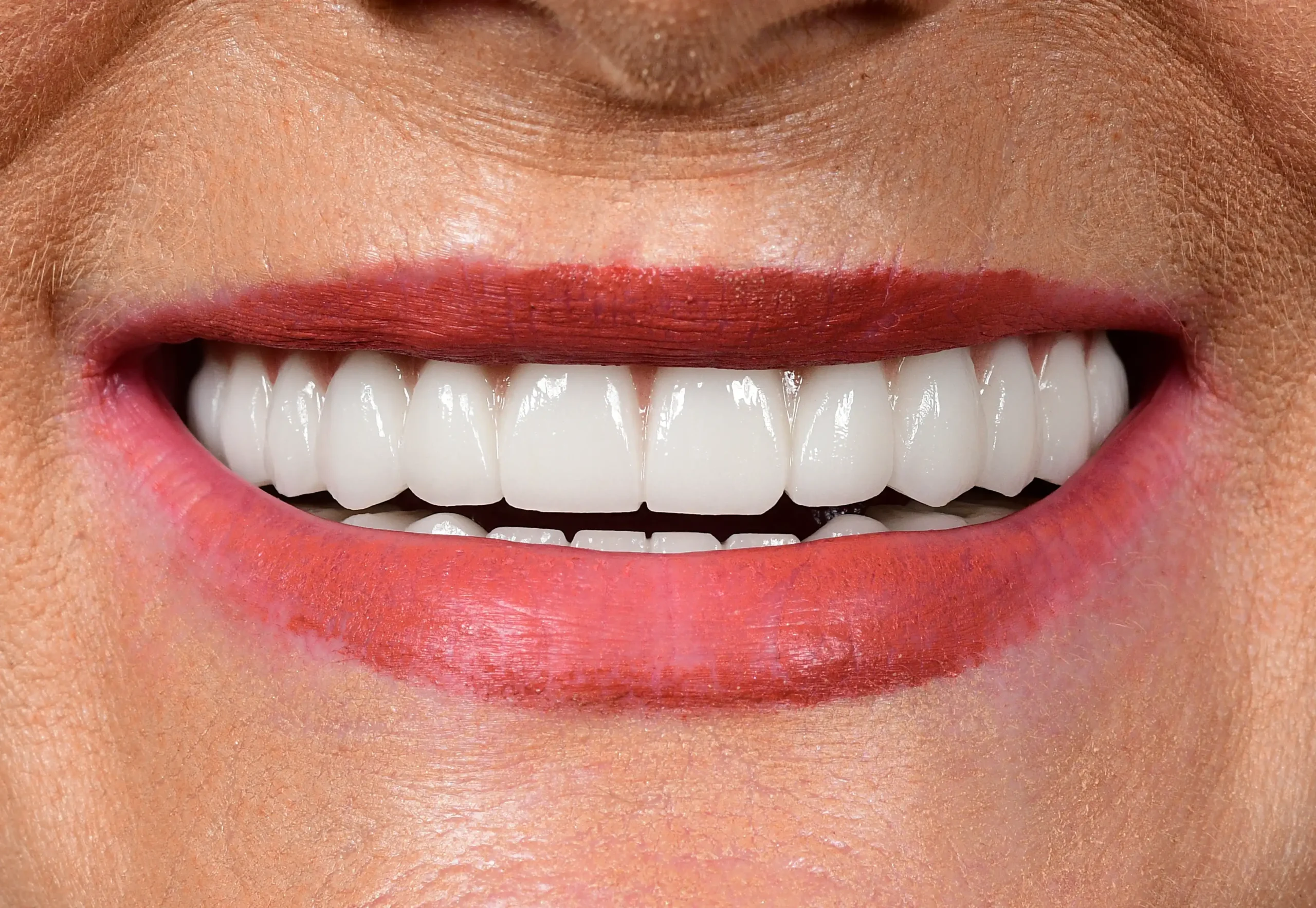 All On 6 Treatment — After