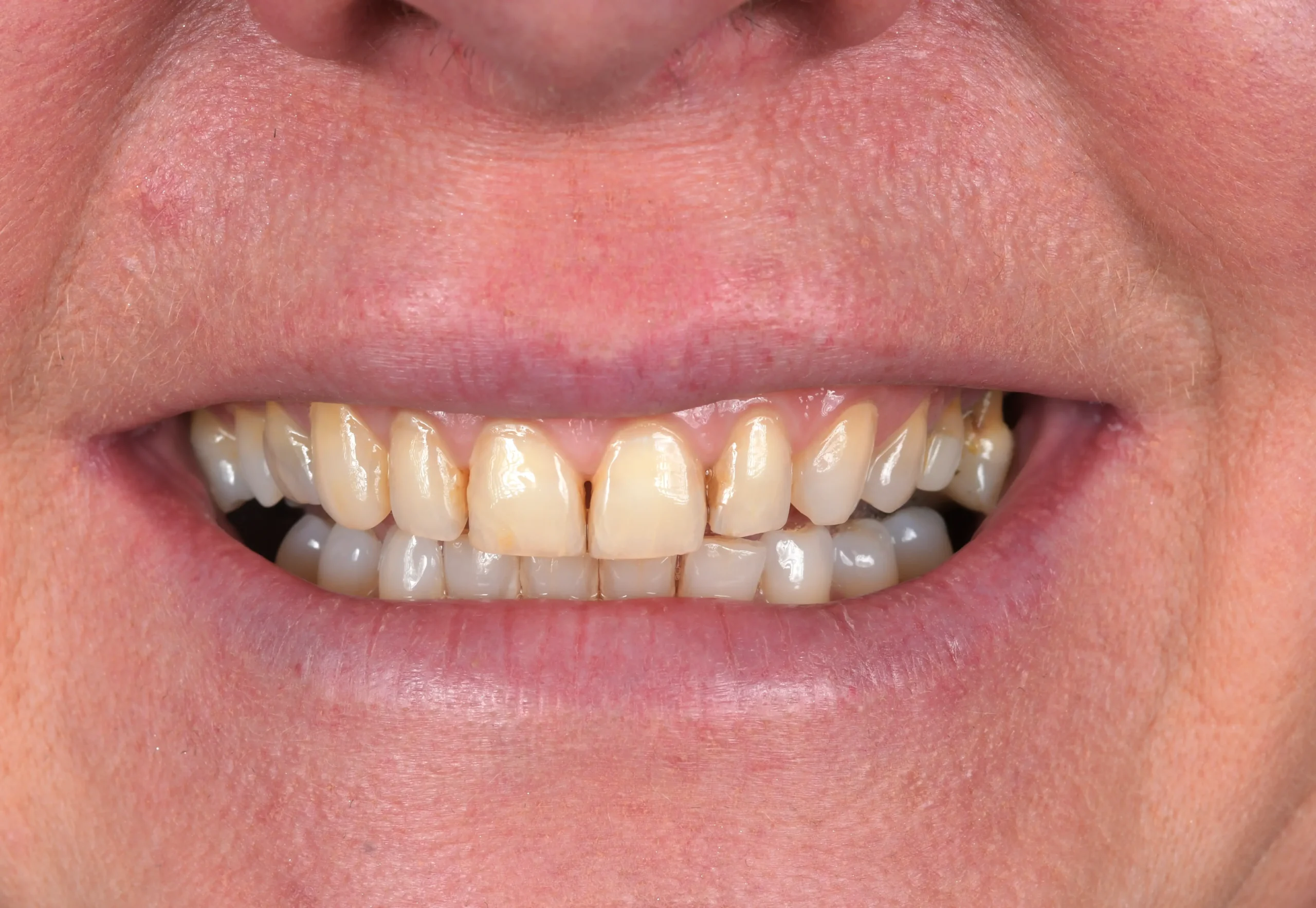 Hollywood Smile Makeover — Before