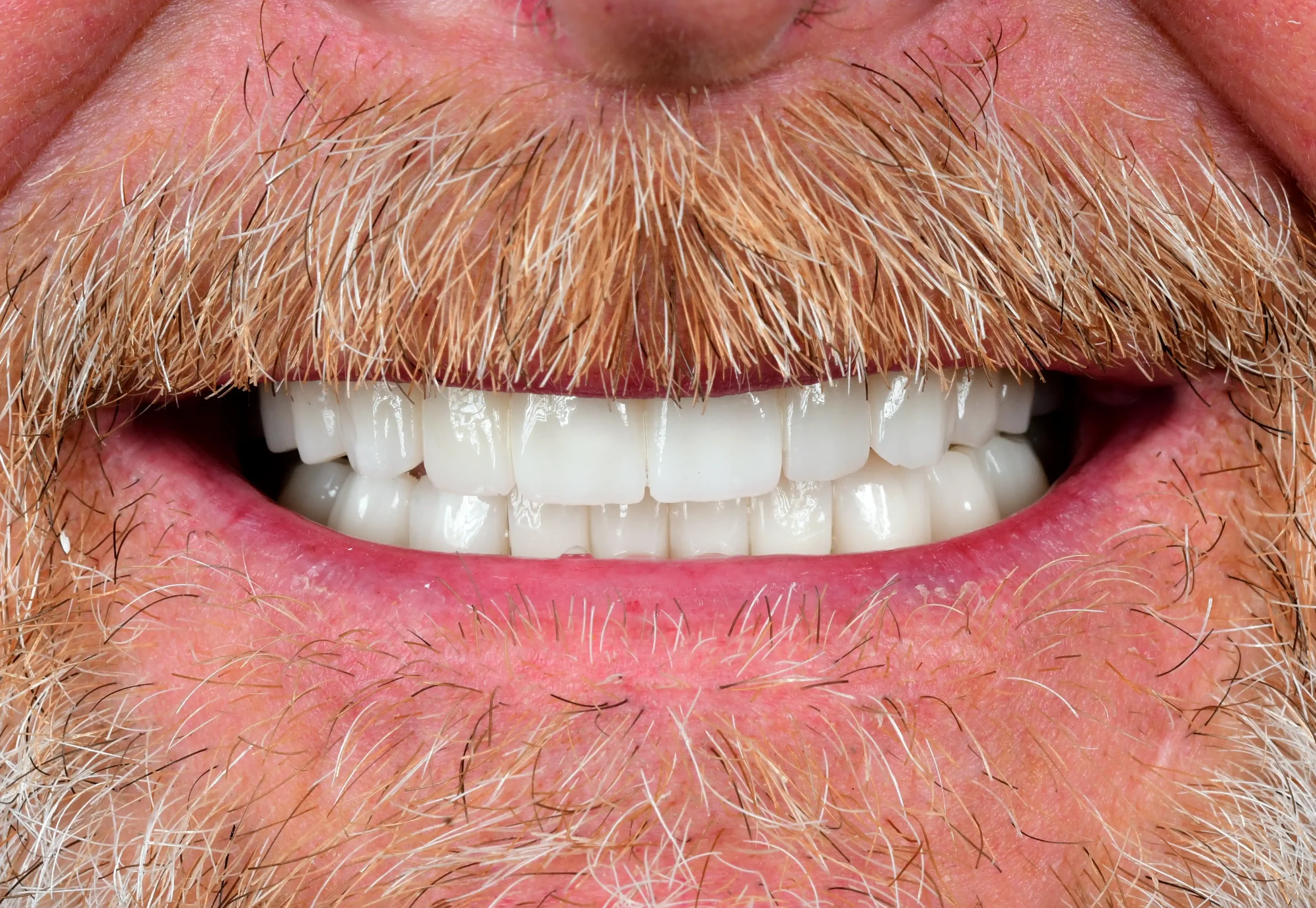 Natural Smile Makeover — After