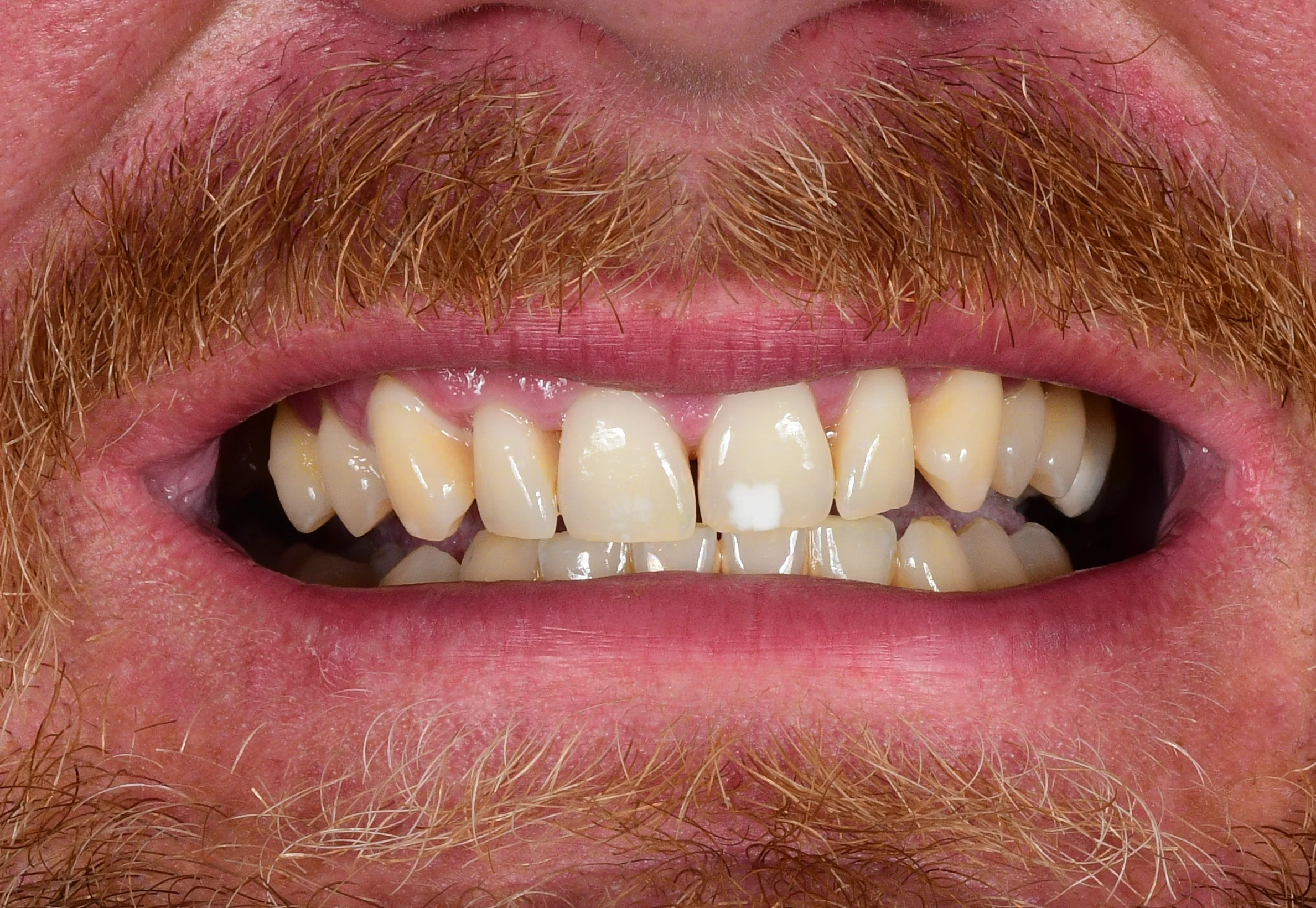 Natural Smile Makeover — Before