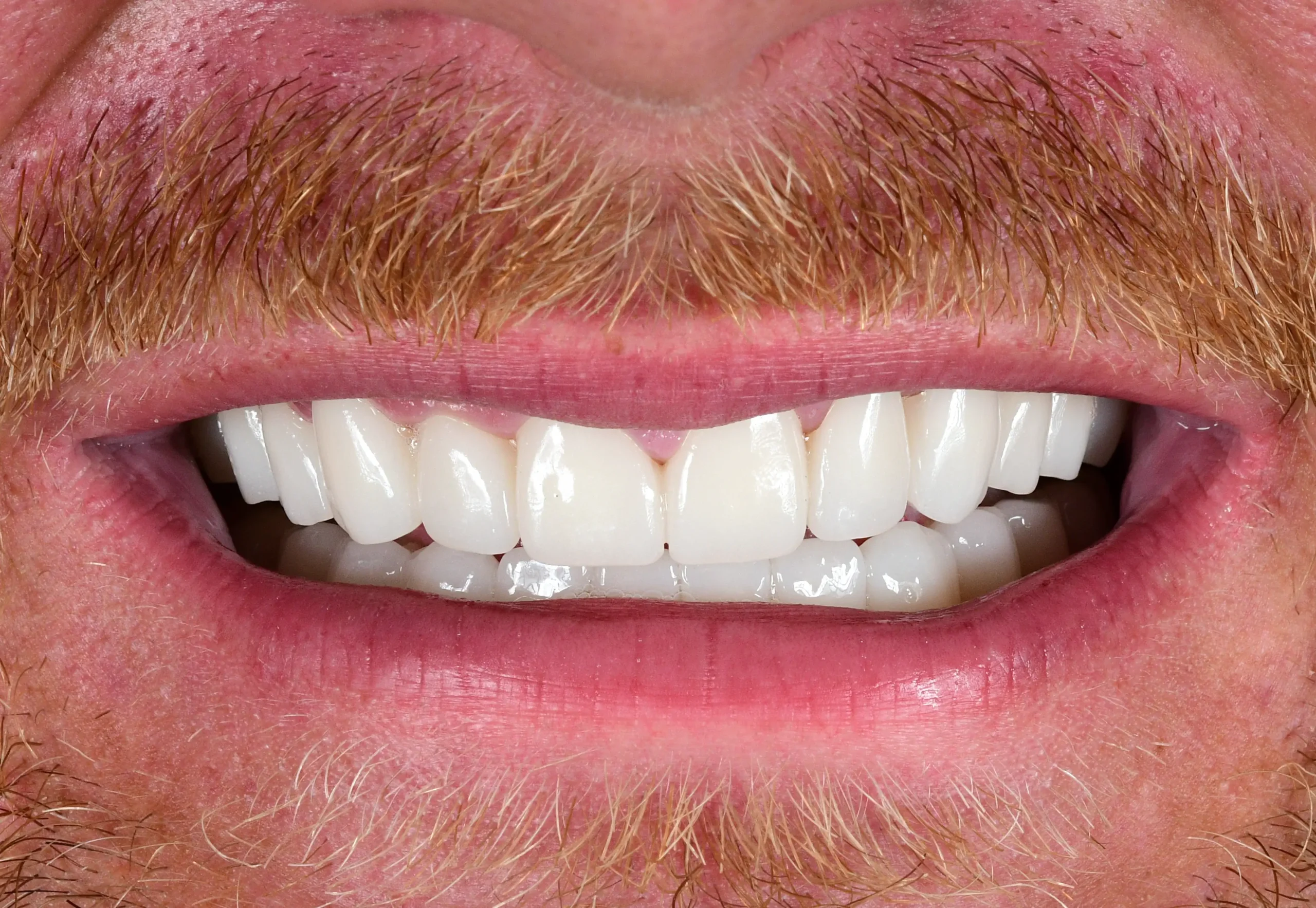 Natural Smile Makeover — After