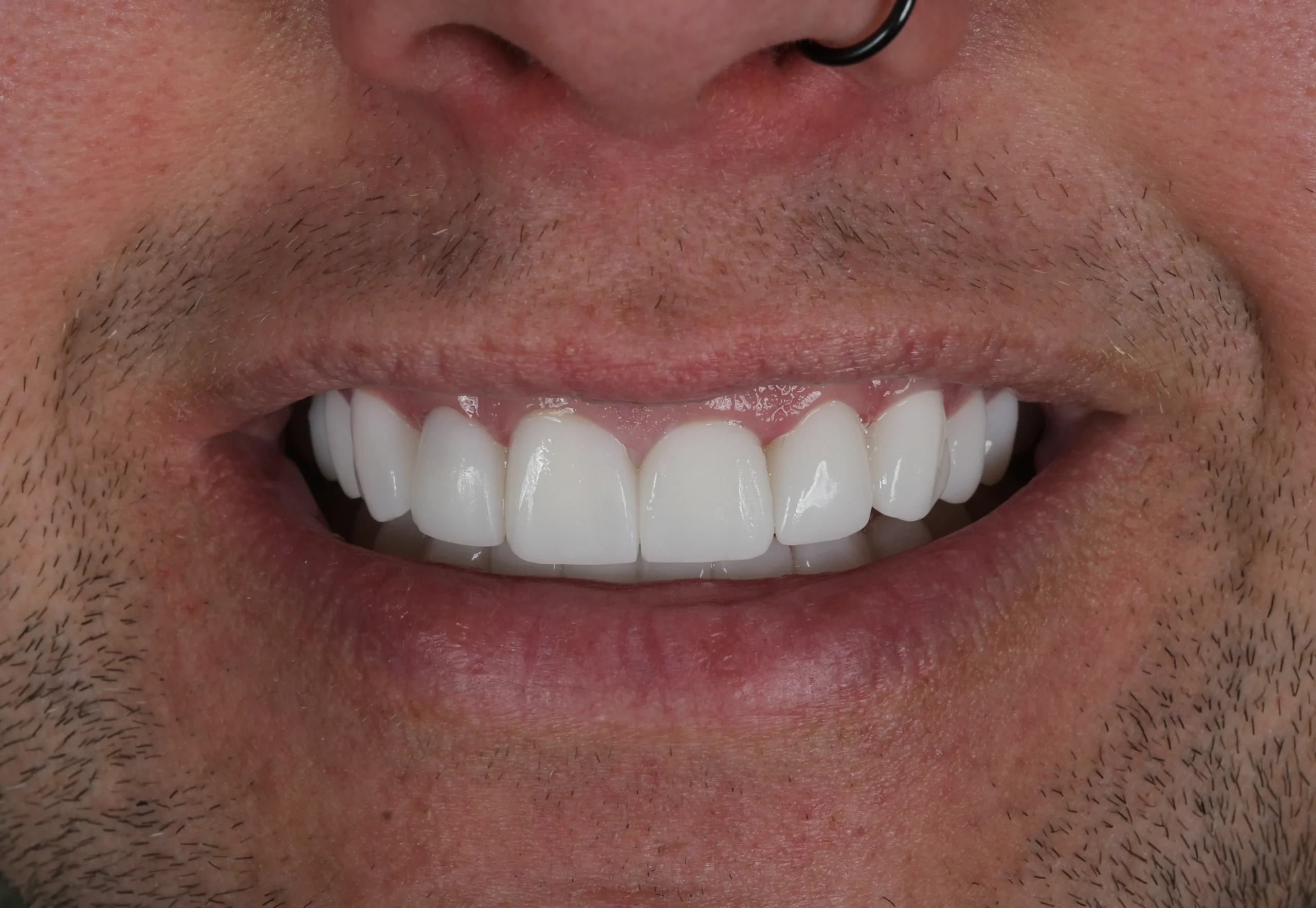 Hollywood Smile Makeover — After