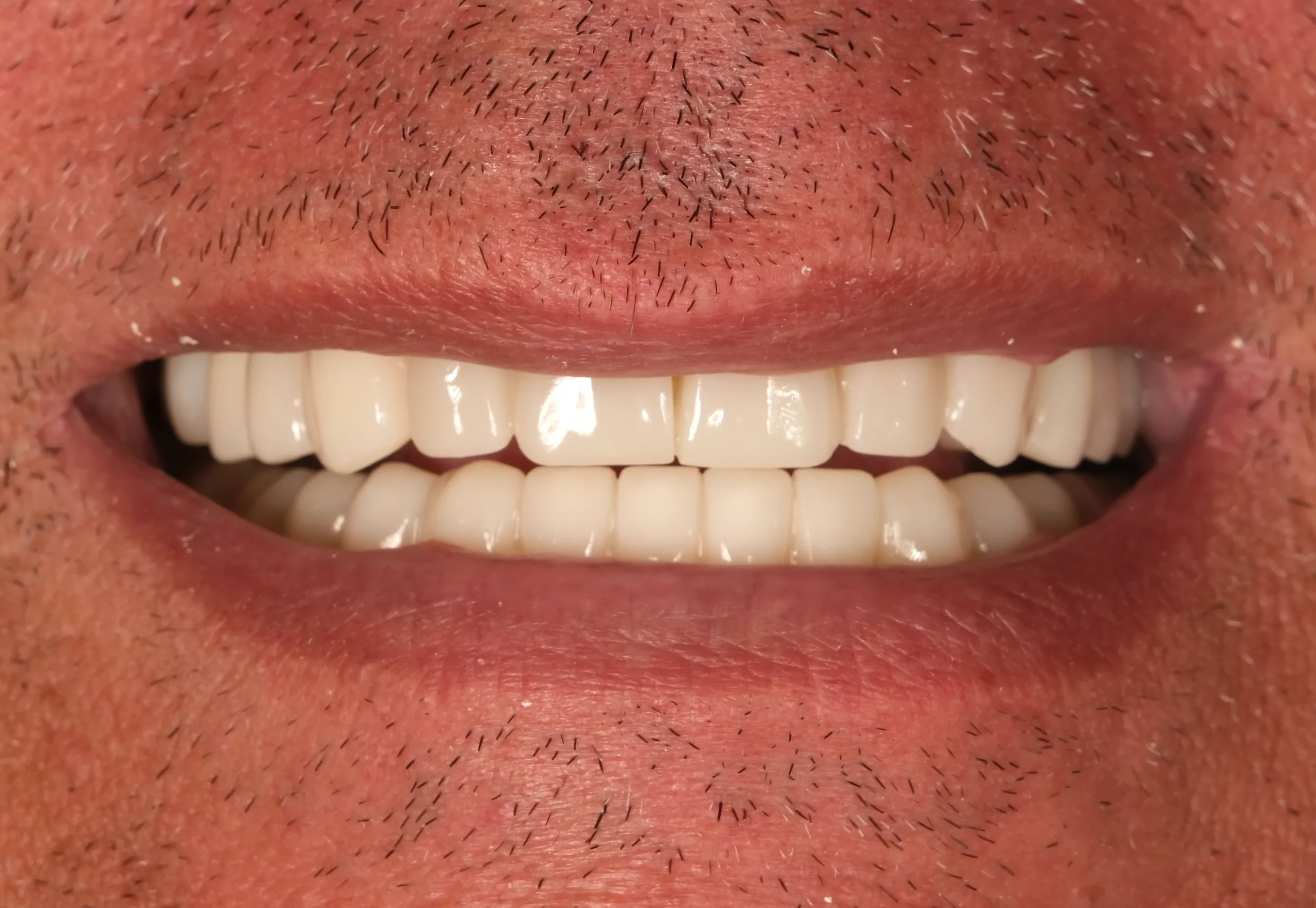 Natural Smile Makeover — After