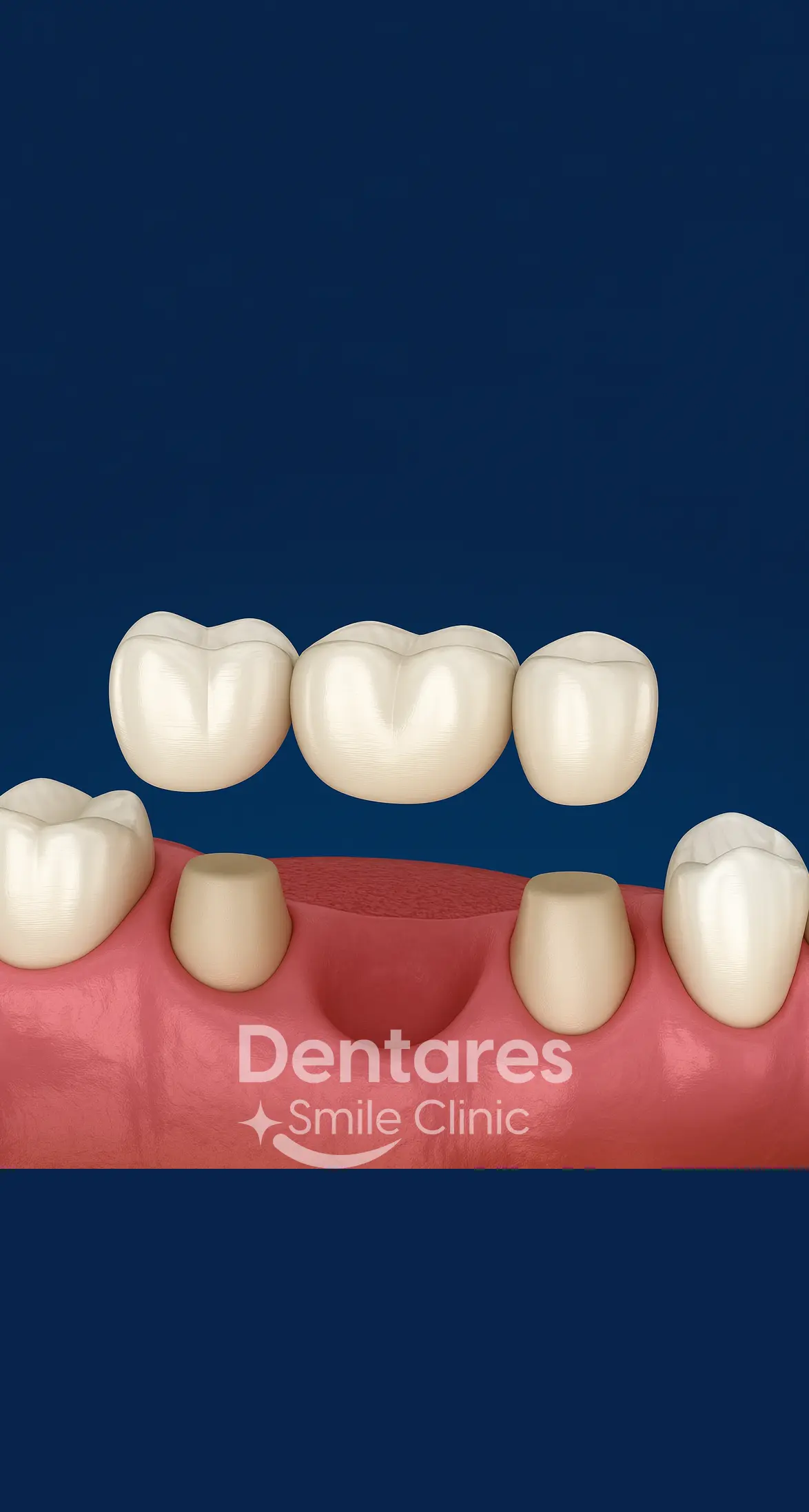Dental Bridge