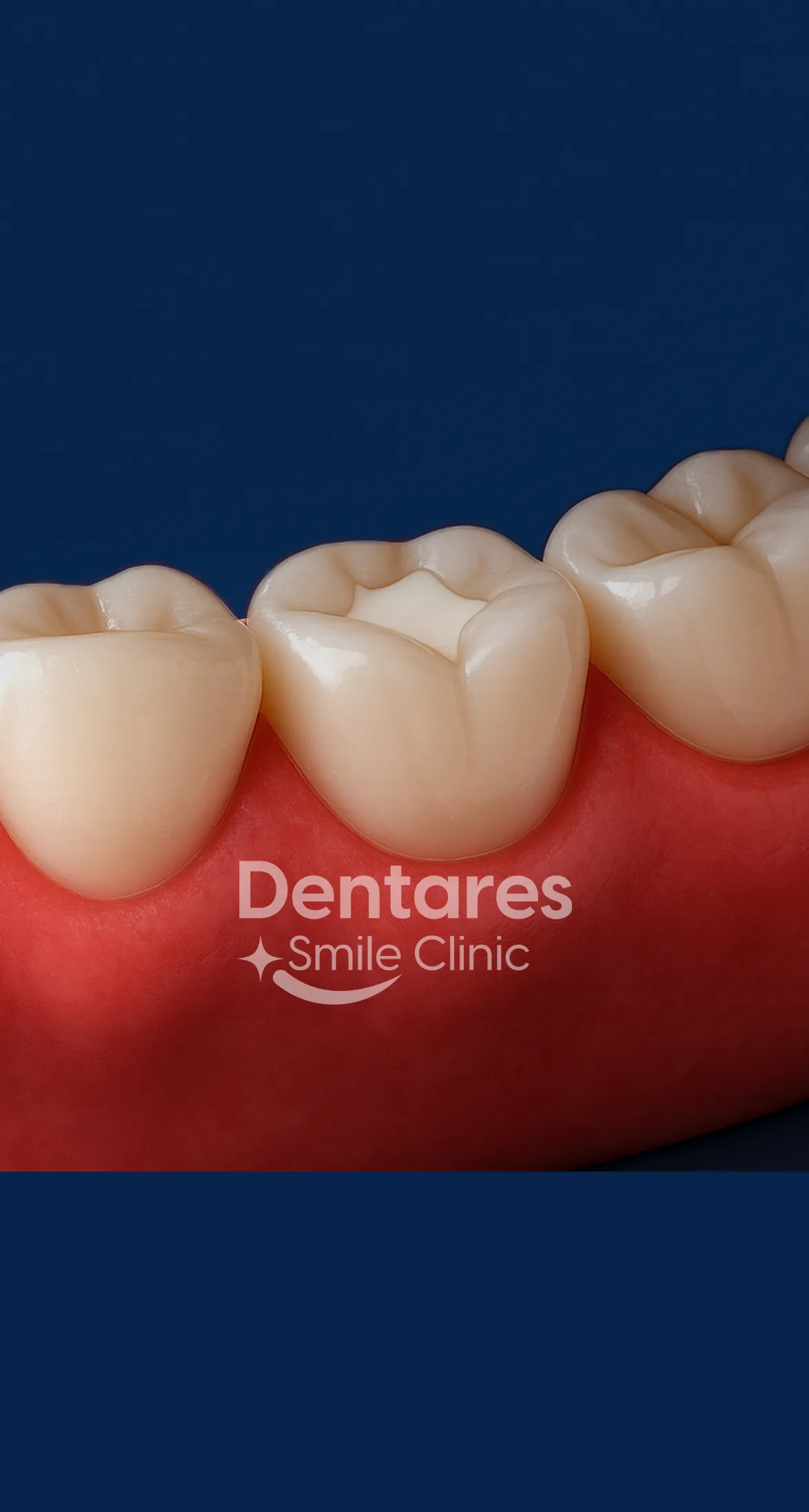 White Composite Filling 